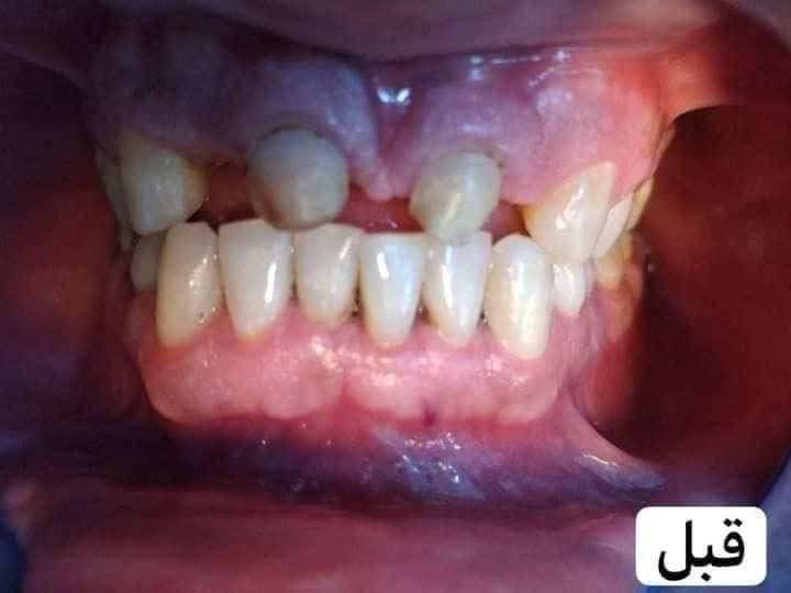 اللي يريد يحجز يتصل او يدز عالخاص
عيادة طب الاسنان 
تقويم الاسنان ،، زراعة الاسنان ،، حشوات تجميلية
تركيب الاسنان (سيراميك و زارگون)،، حشوات جذور ،، قلع،، حشوات مؤقتة ودائمية ،، تنظيف وتلميع الاسنان ،، تبييض الاسنان بالليزر 
متواجدين طيلة أيام الاسبوع 
للحجز والاستفسار ع الخاص او ع الرقم 
*********** واتساب 
العنوان .. الامين الثانية شارع البنازيخانة يم السوگ 
قریب ع افران السلام واسواق الشارقة مقابل محلات الصبيحاوي
مجمع دكتورة رجاء محمد نصيري
