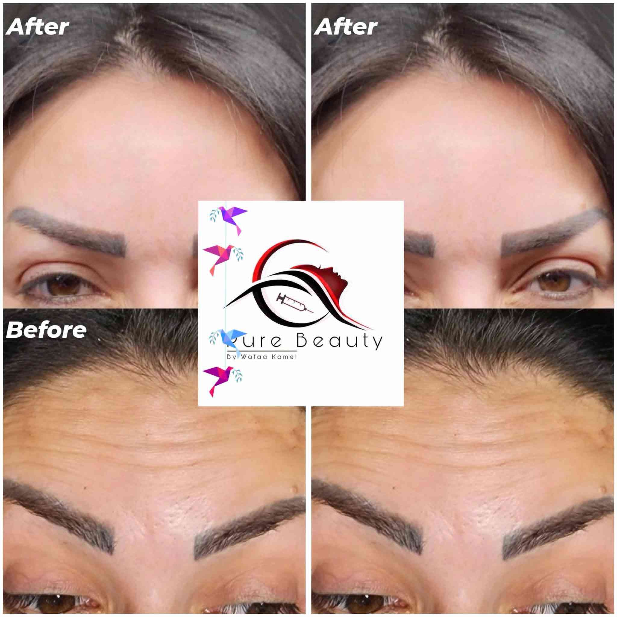 هلاو يا بنات 🥰💖 العيد قرب وحان الوقت لتبرزي جمالج الطبيعي بأحلى شكل! ✨
مع Pure Beauty للتجميل الجراحي، كل عملية تجميل عندنا بتكون احترافية وفخمة، والتفاصيل الصغيرة تصنع فرق كبير 😍💎
والأفضل؟ عروضنا الخاصة رح تخلي التجربة أكثر مغرية وكل بنت رح تحس بالتميز 🔥💫
📍 المكان: داخل مجمع بسمايه السكني
📲 للحجز: واتساب ***********
دللي نفسك وخلي جمالك يتألق بأمان واحترافية 😘✨
https://www.facebook.com/share/1C9cHiuph9/?mibextid=wwXIfr
