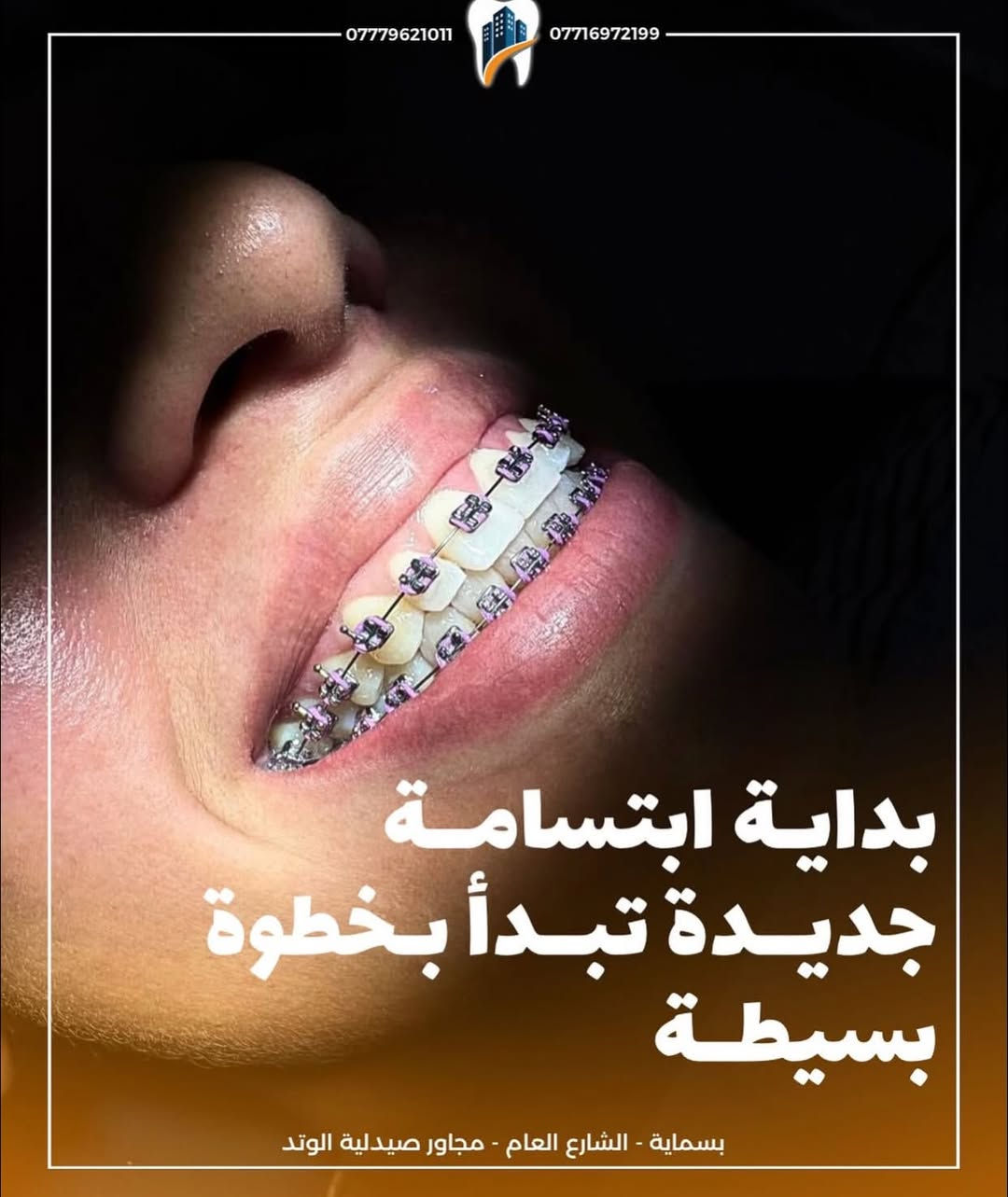 🦷✨ ابتسامتك الحلوة تبدي بخطوة وحدة… ويانه تصير حقيقة!

إذا تعانين من تزاحم الأسنان أو فراغات وتردين ابتسامة مرتبة وجذابة، عيادة الوتد لتجميل وطب الأسنان توفر لج أفضل حلول تقويم الأسنان بإشراف الدكتور علي حسين حسب الله. 👨🏻‍⚕️

🔹 التقويم المعدني: خيار عملي ونتائج مضمونة.
🔹 التقويم الشفاف: أنيق، مريح، وشبه غير مرئي حتى تحافظين على جمال ابتسامتج أثناء العلاج.

✅ متابعة مستمرة.
✅ خطة علاج تناسب كل حالة.
✅ عناية واهتمام بأدق التفاصيل حتى توصلين للنتيجة اللي تحلمين بيها.

📍 العنوان: بسماية – الشارع العام – مجاور صيدلية الوتد.
📩 للحجز والاستفسار: دايركت.

عيادة الوتد لتجميل وطب الأسنان… لأن ابتسامتج تستحق الأفضل. 😁🦷

‭***********‬
#الوتد_لتجميل_وطب_الاسنان #اكسبلور #متابعة
