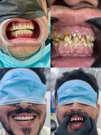 حشوات تجميليه ب 25 الف حسب تلافه ألسن  تنضيف أسنان وبولش للاسنان ب 20 ...