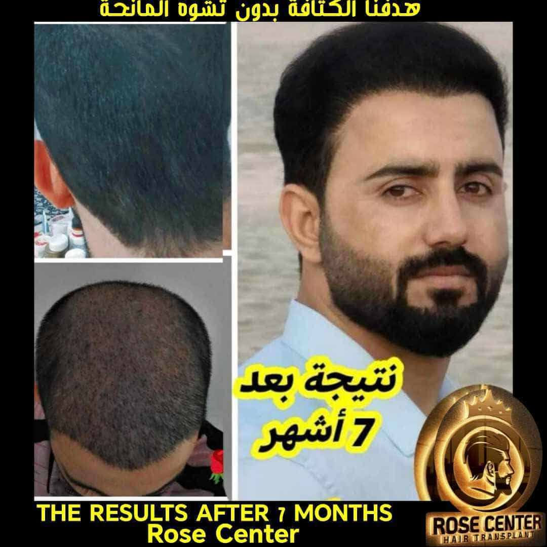 معكم الاستشارية طبيه يسر
تحب تزرع لا تحتار كلينك روز اقدم وارقي مركز بغداد كثافة وشكل مميز مرتب مع شهادة ضمان

واني اسويلك معاينه مضبوطة واتابع حالتك طول فترة الزراعة 🩵🌷

فقط اتصل

***********

متوفر واتساب 👆
