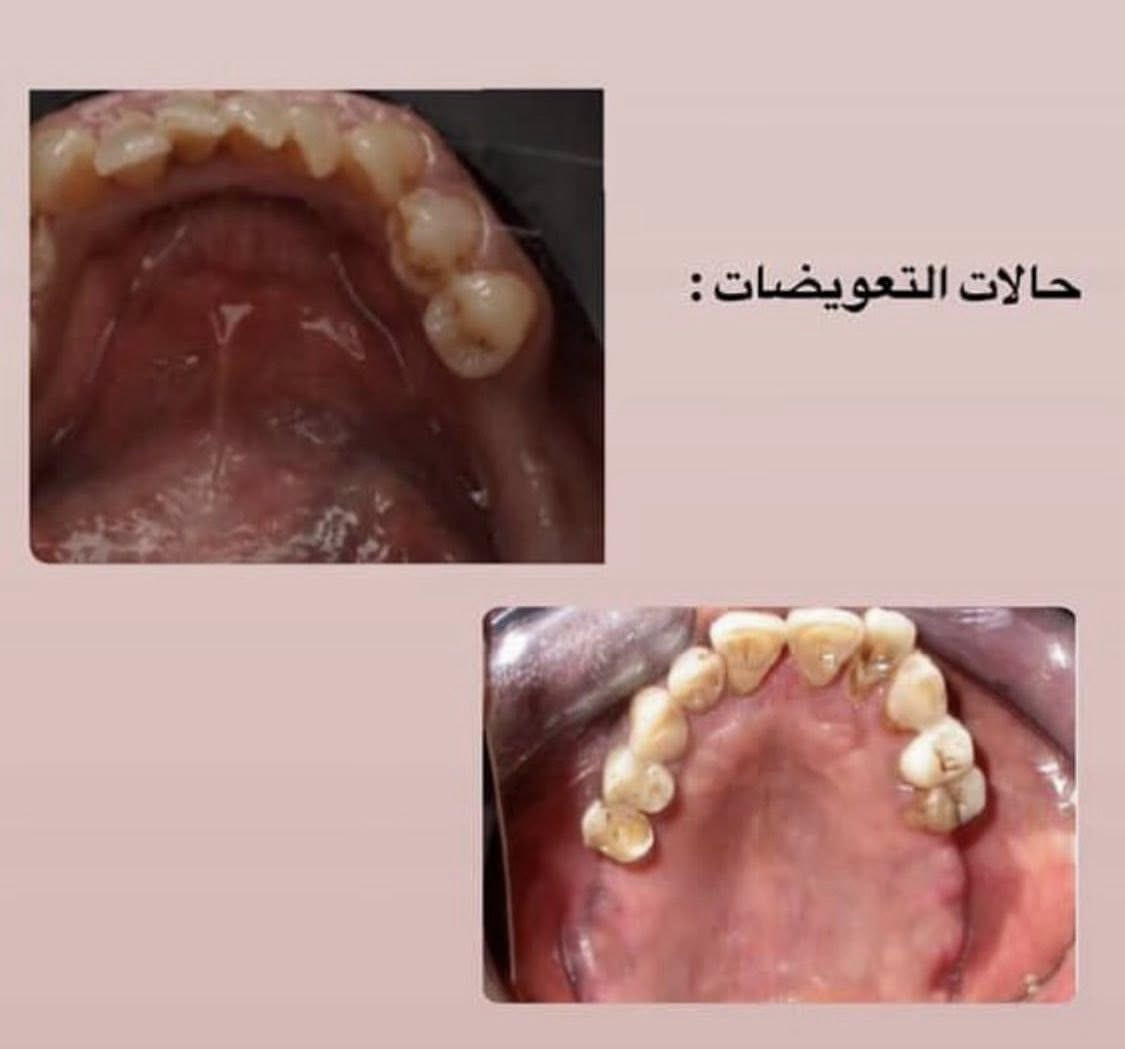 السلام عليكم  متوفر لدينا علاج مجاني بالكامل للحالات المذكورة 👇
1- حشوات تجميليه ( بيضاء) .🦷
2-قلع بقايا جذور الاسنان .🦷
3- تنظيف الاسنان وازالة التكلسات .🦷🪥
4- تعويض الاسنان المفقودة بطقم (تخم) متحرك .🦷

☎️للحجر او الاستفسار مراسلة الصفحة على
الماسنجر او واتساب 📞***********
