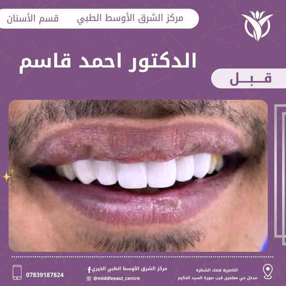 حالة علاجية من مركزنا 
للدكتور احمد قاسم 

شنو رايكم بشكل الابتسامة بعد العلاج 😍

🕠أوقات دوام المركز خلال أيام الأسبوع
🕠صباحاً من الساعه 8:00 الى الساعه 12:00ظهراً
🕠مساءً من الساعه 2:30 ظهراً الى الساعه 9:00ليلاً

📍العنوان الشطرة مدخل حي المعلمين قرب صورة السيد الحكيم 

📞الأستفسار أكثر الإتصال على الرقم التالي ***********⁩
