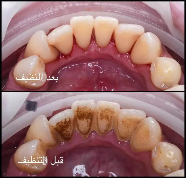 مجانا مجانًا
🛑 تنظيف الاسنان وازاله التكلسات والتصبغات  
 
♦️الوقاية من التهاب اللثة.�♦️الحصول على نَفَس منعش، وذلك بالوقاية من تكون البكتريا المسببة للروائح الكريهة.�♦️الإقلال من تكون التصبغات الخارجية على أسطح الأسنان.

للتواصل والاستفسار اكثر مراسله الصفحه
واتساب ***********
