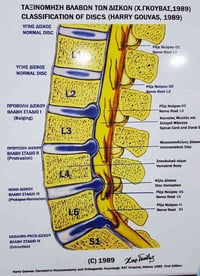 إنزلاق الفقرات القطنية  يحدث إلانزلاق في الظهر نتيجة خروج الغضروف المو...
