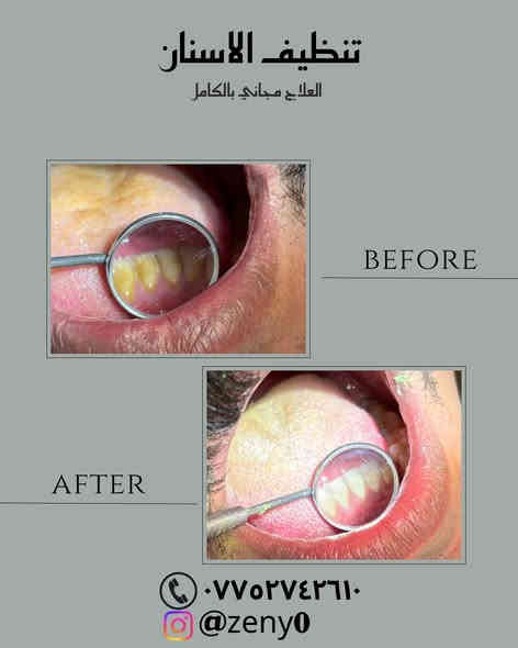 علاج مجاني بالكامل 🕊️
الخدمات المتوفرة :
🕊️فحص الاسنان
🕊️قلع الاسنان التالفه وجذور الاسنان المتبقيه
🕊️" تنظيف الاسنان وازالة التكلسات
🕊️حشوات ضوئية بيضاء تجميليه لعلاج تسوس وكسر الاسنان الاماميه
🕊️تعويض الاسنان المفقودة بطقم جزئي متحرك
🕊️(العلاج مجاني بالكامل)
📍• العنوان : بغداد جامعة الفراهيدي – حي القادسية، شارع قطر الندى، قرب جامعة ابن سينا للعلوم الطبية وبالقرب من جسر الجادرية
💕للتواصل : د. زينب محمد الرشيد
واتساب |***********
Zeny0/ انستا
