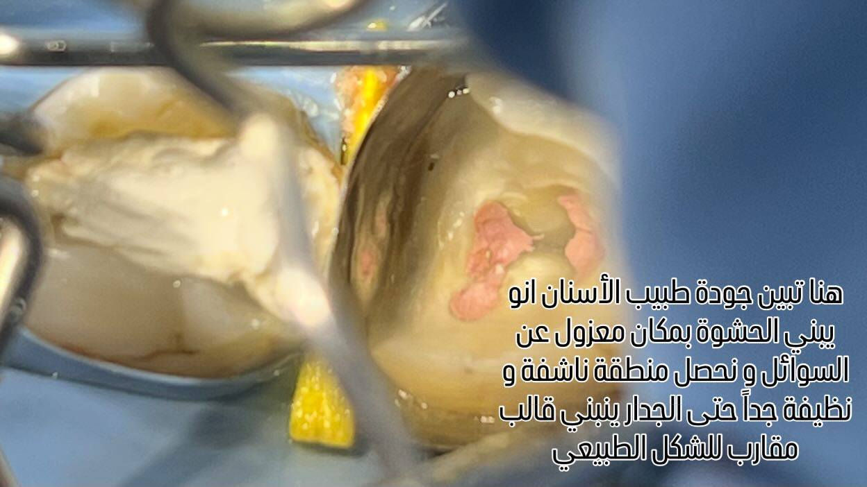 خطوات حشوت الجذر داخل العيادة  
صحة اسنانك ويا عيادة بيانو غير 🥰
 
المكان/ حي 17 الشارع العام لمكتبة المهندس مجاور لمدرسة المشاعل

 للحجز والاستفسار/ ***********
