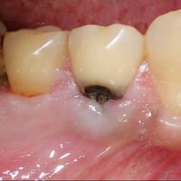 الي عنده هيج تسوس يراسلني علاج مجانا 07802888723