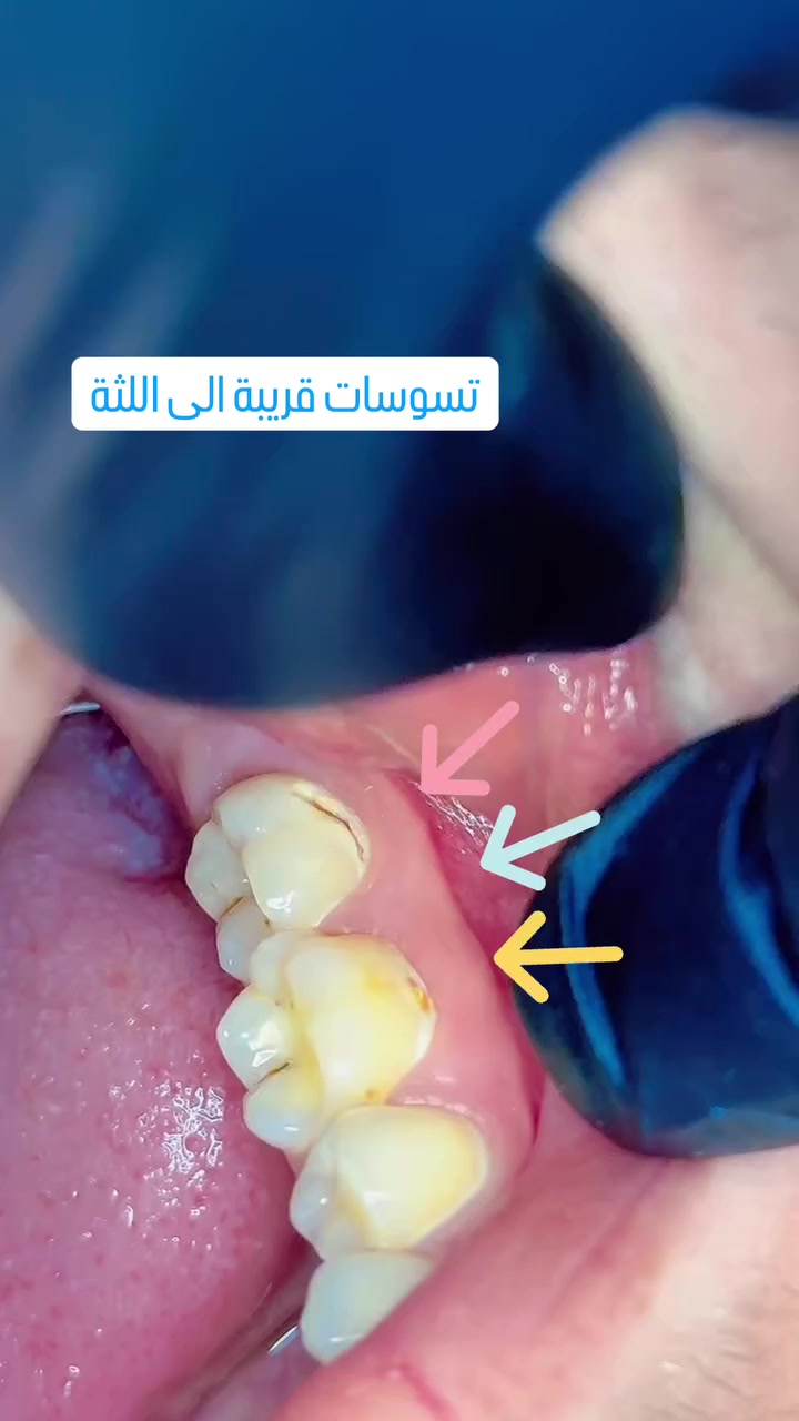 للحجز ***********
#عيادة_الدكتور_حسنين_العلوان_لطب_الاسنان
