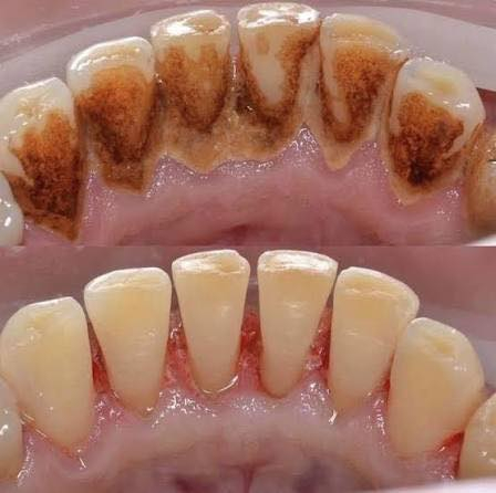 لا تأجل علاجك بعد اليوم.ف العلاج مجاني 📍
في عيادات جامعة الصفوة – كربلاء / حي النقيب / شارع النهر نوفر لك رعاية متكاملة لكل مشاكل الفم والأسنان تحت إشراف أطباء اختصاص وبأحدث الطرق العلاجية.

🔹 قلع الأسنان التالفة بدون معاناة
🔹 تنظيف التكلسات واستعادة صحة اللثة
🔹 معالجة أمراض الفم وآلام مفصل الفك
🔹 علاج شامل لأسنان الأطفال بعناية واهتمام
🔹 تعويض الأسنان المفقودة وإرجاع ثقتك بابتسامتك
🔹 تركيب أطقم أسنان كاملة بشكل مريح وطبيعي
🔹وجميع الحشوات ومن ضمنها حشوات الجذور 

💡 والأهم؟ العلاج مجاني بالكامل مع متابعة طبية دقيقة لضمان أفضل نتيجة.

لا تخلي الألم يمنعك من الابتسام 😊
📍 زورونا في كربلاء – حي النقيب – عيادات جامعة الصفوة
وخلّي ابتسامتك ترجع أجمل من قبل.
 
للحجز راسلونا على الخاص او التواصل عبر 
*********** 
الدكتوره :زينب حسين كاظم
