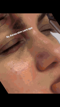 جلسة تنظيف بشرة • مايكرونيدلنك • مركز تجميل