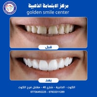 ابتسامة هوليود • E-Max • الكوت الخاجية