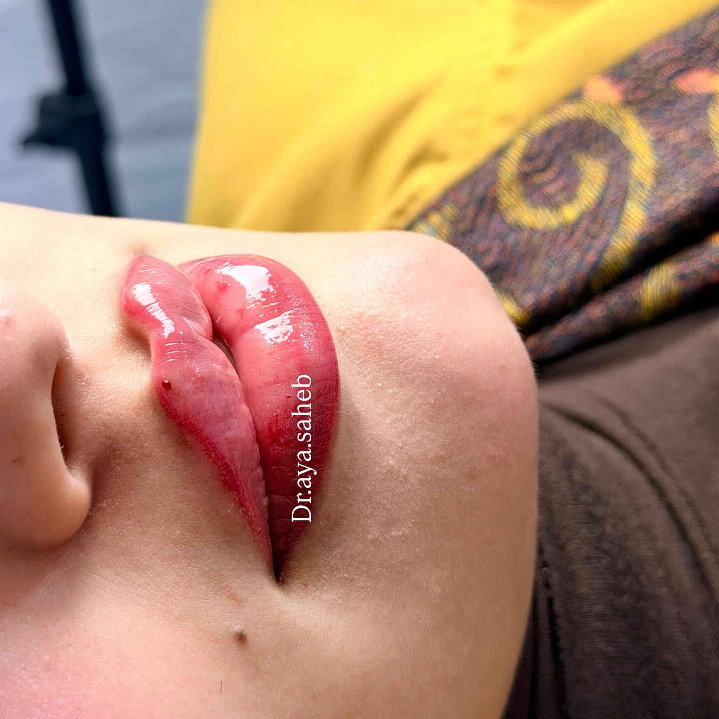 الدكتورة آيه صاحب
الديوانية 📍
للحجز والاستفسار/***********
#فلر #فلر_شفايف #فلر_تيوسيال_السويسري #فلر_شفاه
