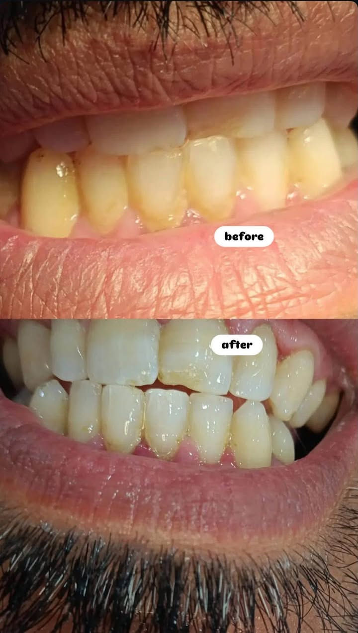 �🔶🔶 مجاناً 🔶🔶🔶
ببركة الله، نعلن عن تقديم خدمات علاج الأسنان مجاناً

ابتداءً من 22 محرم ولغاية 22 صفر.

ايام العمل: الاثنين/ الثلاثاء/ الأربعاء 

🦷 الخدمات تشمل:

• تنظيف الأسنان

• الحشوات

• القلع

📲 للحجز والاستفسار، يرجى مراسلتنا على الواتساب:

***********

كربلاء ♦️
