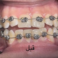 رفع التقويم بعد ترتيب وتعديل الاسنان للفكين طبيب الاسنان الاختصاص د.عم...
