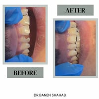 بعد اليوم لا وجع ولا تردّد ✨ حشوة ضوئية 20 ألف حشوة جذر 20 ألف تنظيف أ...