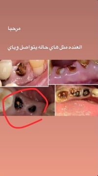 يحتاج قلع أو حشوات يتواصل وياي مجاني 07827964441