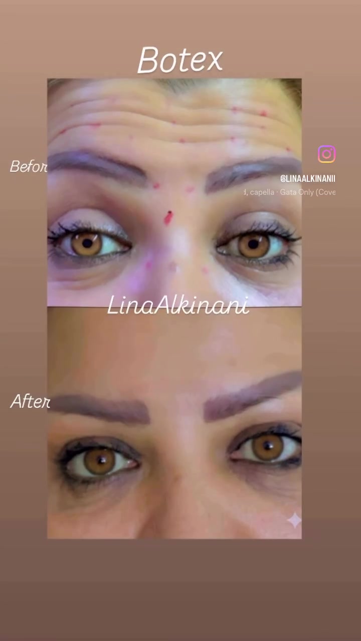 😍عرووووووض العيد 😍
😍 ✨ عيادة النبضة التجميلية ✨😍
لأن جمالج يستحق عناية بأدق التفاصيل 💉🤍

نوفر أحدث تقنيات التجميل اللاجراحي بأيدي خبيرة ونتائج طبيعية راقية ✨
🔹 حقن الفيلر
🔹 البوتكس
🔹 الميزوثيرابي
🔹 البلازما PRP
🔹 تفتيح ونضارة البشرة
🔹 جلسات الهيدرافيشل والعناية الملكية
🔹 علاج التصبغات والهالات
🔹 تحديد وكونتور للوجه والشفايف

نهتم براحتج، تعقيم عالي، وشغل ناعم يبرز جمالج بثقة وأناقة 💎

📍الموقع: بغداد – حي العامل-الجنابات -قرب روضة النسرين
🏥 عيادة النبضة التجميلية
***********

احجزي موعدج وخلي جمالج ينبض ثقة
