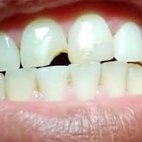 حشوات تجميلية • أسنان أمامية • بالمجان