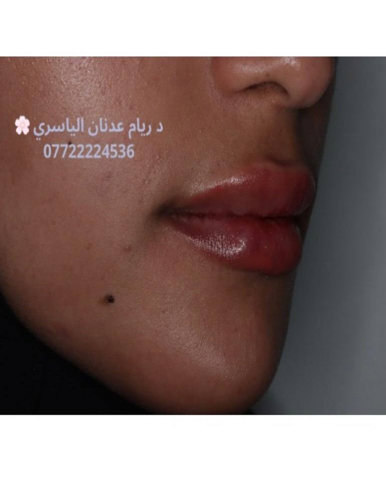 ✨ لأن صحتك وجمالك يستاهلون الأفضل ✨
تقدم لكم عيادة [الضياء سمايل]
أفضل الخدمات الطبية والتجميلية بأحدث الأجهزة وعلى أيدي مختصين 💉🌸
✔️ استشارات طبية دقيقة
✔️ جلسات تجميل وعناية بالأسنان
✔️ نتائج مضمونة واهتمام بأدق التفاصيل
📍 الموقع: [السماوه حي المعلمين مقابل نيكست لفل]
📞 للحجز والاستفسار: [***********]
💖 راحتك وثقتك بين إيدينا 💖

https://www.instagram.com/dr.riyam_alyasiri?igsh=N2xva2FtOHNpNXpi
