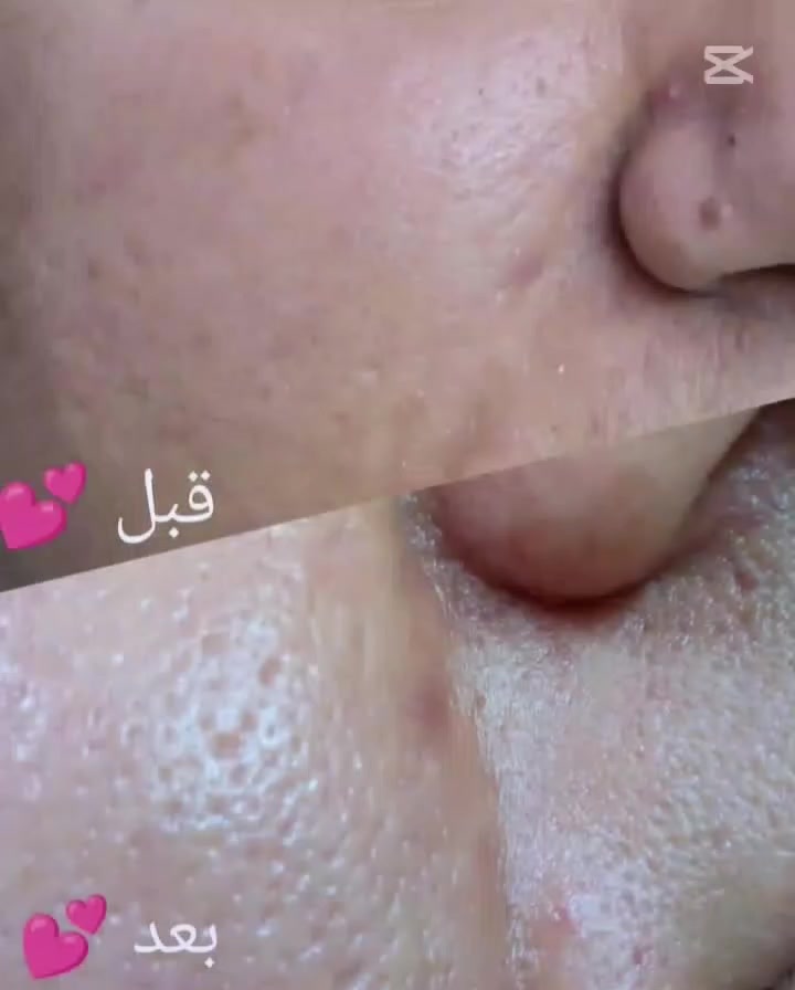 كُلُّ شَيْءٍ يُصْبِحُ جَمِيلًا حِينَ نُقَرِرُ 
أَنْ نَرَاهُ جَمِيلًا، نَحْنُ أَسْيَادُ مَشَاعِرِنَا."💕🌸 بنات واسط الجميلات حفافه وشمع بارد مع تنضيف بشره بسيط فقط 5الاف جلسة نضاره البشره لكلف العميق وتصبغات اسعار مناسبه جدا تقشير الطبي للجسم والبشره خصم ٢٥٪


**إذا كنت صاحب هذا الإعلان وتريد حذفه لأي سبب، رجاءا أرسل رسالة إلى الدعم الفني**