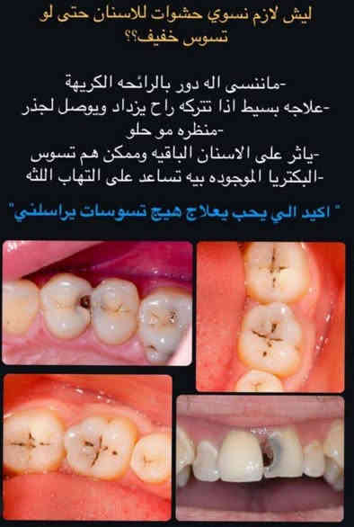 تعلن عيادات  اللصفوه التخصصية لطب الأسنان عن بدء استقبالها للمراجعين وتقديم الخدمات الطبية
مجاناً بإشراف أطباء مختصين للحالات التالية:

حشوات ضوئية دائمة للأسنان (مجاناً)

تنظيف وازالة  تكلسات الاسنان ( مجانًا )

قلع الأسنان التالفه وبقايا الجذور (مجاناً)

تعويض الأسنان المفقودة بقالب أسنان متحرك

حي النقيب/ شارع النهر

للحجز والاستفسار *********** واتساب
***********
