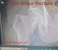 🔴 يوم الخميس عصرا يتواجد الدكتور حسن محي الدين رشيد 

                         دكتوراه أخصائي امراض وجراحة العظام والكسور والتهاب المفاصل وتبديل المفاصل والروماتيزم والاصابات الرياضية

‏‎ العمليات التي يجريها الطبيب:
✅علاج انزلاق الفقرات
✅ العمليات الناظورية والمجهرية للعمود الفقري بتداخل محدود
✅عمليات تبديل المفاصل 
✅ عمليات الأصابات الرياضية
✅جراحة العظام والكسور
                                    
 🟢 للحجز والاستفسار  :*********** - ***********

🟢العنوان / مجمع الثقة الطبي طوزخورماتو / شارعة الصاغة / قرب مدرسة يافا الابتدائية
