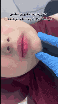 شفة كرزية 🍒 بالفلر الايطالي 1cc للحجز/07751761505