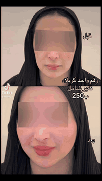 قبل / بعد ✨تحديد ناعم… نتيجة طبيعيةعيادة سنايا 🤍#فيلر #بوتوكس #شد_الوجه #عناية_بالبشرة تفتيح_البشرة جلسات_العنايةليزر_ازالة_الشعر علاج_البشرة تنظيف_البشرة جهاز_ليزر
كربلاء مقابل مول الحارث
***********
