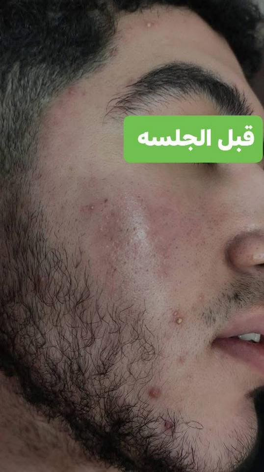 تستقبلكم. الدكتوره.  امل. حسن في مجمع. الق. التاجيات. الطبي.  يومي. الاثنين. والخميس.   لعياده التغذيه.  والتجميل.  ومن عروض.  عياده. التجميل. 
العرض. الاول. جلسه. تنظيف. بشره. بجهاز الهيدروفيشيل  مع جلسه. نضاره.  ب25 الف. 
العرض الثاني. فلر. شفه. الكوري. بسعر. 60 الف. 
العنوان. التاجيات. خلف دائره. المرور.  مجمع. الق. التاجيات. الطبي. للحجز. ***********
