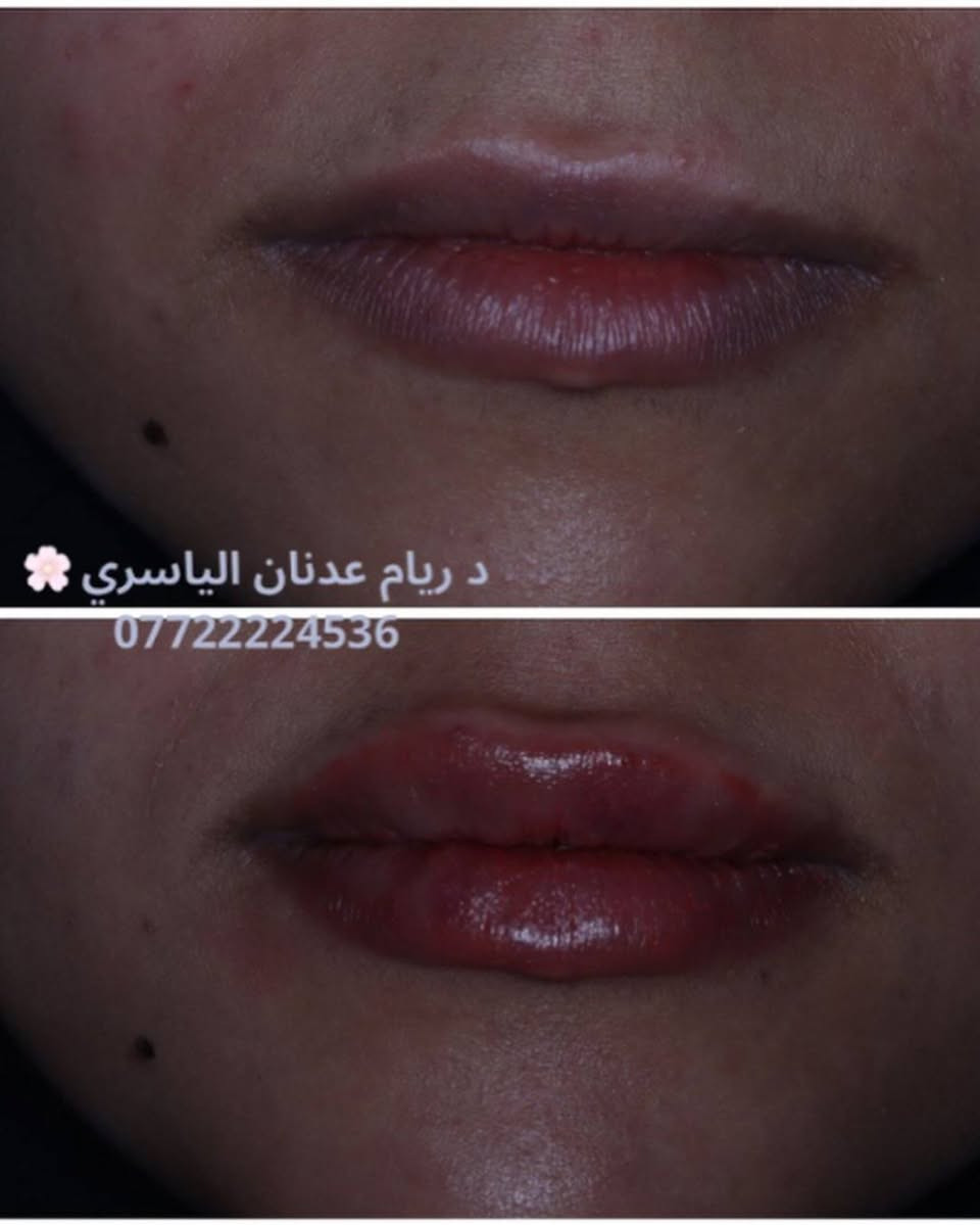 ✨ لأن صحتك وجمالك يستاهلون الأفضل ✨
تقدم لكم عيادة [الضياء سمايل]
أفضل الخدمات الطبية والتجميلية بأحدث الأجهزة وعلى أيدي مختصين 💉🌸
✔️ استشارات طبية دقيقة
✔️ جلسات تجميل وعناية بالأسنان
✔️ نتائج مضمونة واهتمام بأدق التفاصيل
📍 الموقع: [السماوه حي المعلمين مقابل نيكست لفل]
📞 للحجز والاستفسار: [***********]
💖 راحتك وثقتك بين إيدينا 💖

https://www.instagram.com/dr.riyam_alyasiri?igsh=N2xva2FtOHNpNXpi
