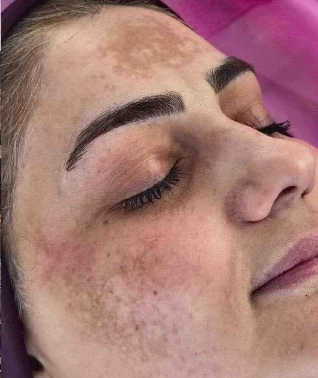 هل تعاني من البقع او التصبغات 
اثار  الناتجة من  الحبوب و التعرض للشمس وعدم توحيد لون بشرتك 😢 انطيك علاج ايخلصك من مشاكل البشرة من توحيد لونها و علاج التصبغات والكلف العميق  و ملئ خطوط منطقة حول العين و علاج الهالات و الانتفاخات
#التفاصيل واتساب  ♥️🌹 بغداد, العراق


**إذا كنت صاحب هذا الإعلان وتريد حذفه لأي سبب، رجاءا أرسل رسالة إلى الدعم الفني**