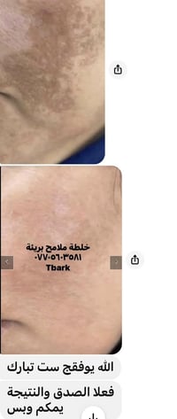 تفتيح البشرة • معالجة الكلف • بلا اضرار
