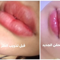 تذويب فلر قديم متكتل وحقن فلر جديد من اعمالي الماكيره هدو صالون هوى بغ...
