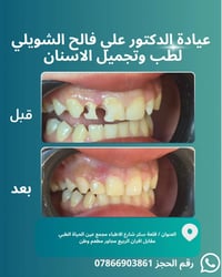 عيادة أسنان • حشوة جذر • حشوات ضوئية تجميلية • تجميل الأسنان • استعادة...