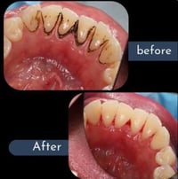 تنظيف اسنان • مجاني • الجامعة الوطنية