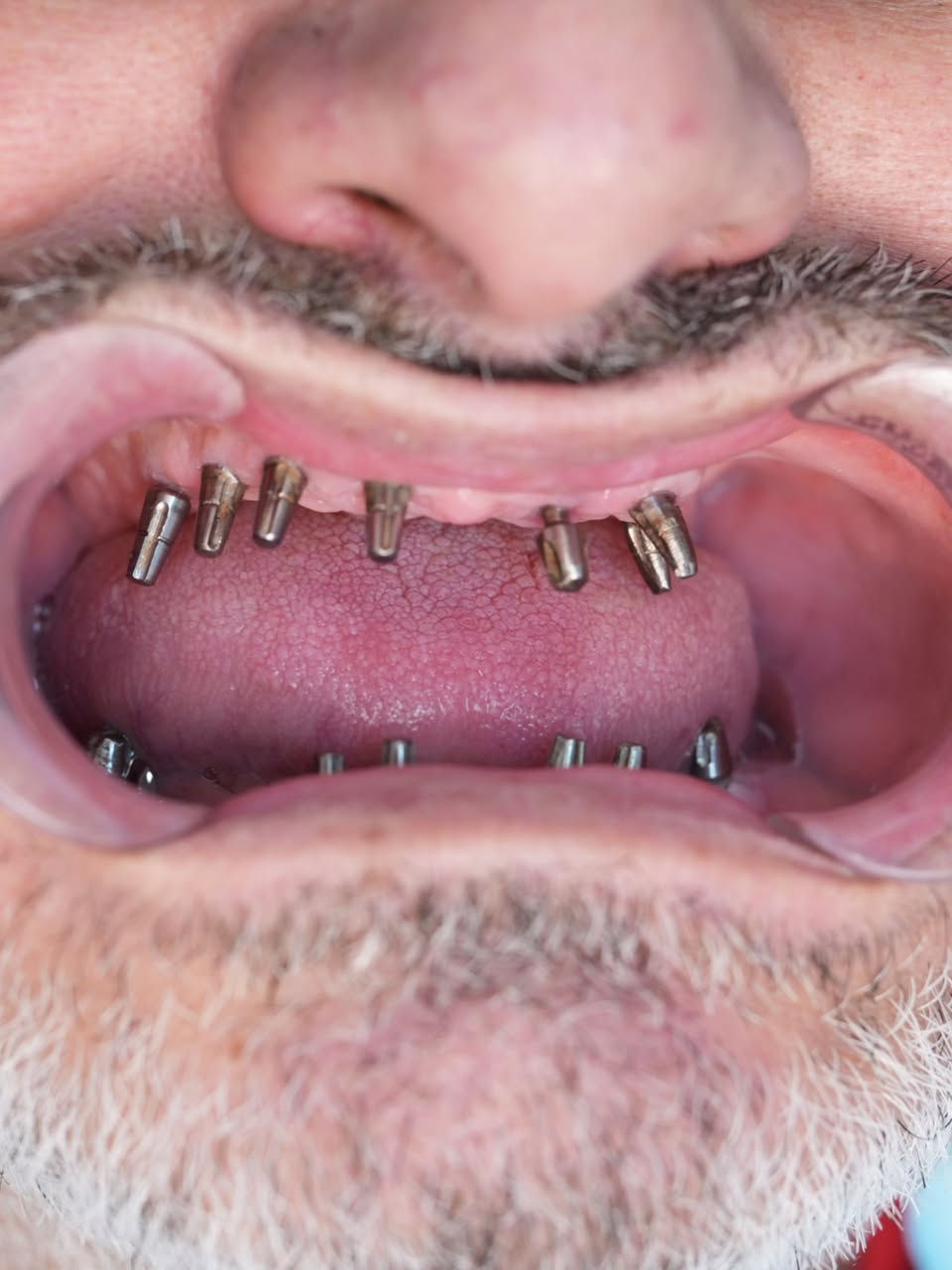 حالة زراعة فك كامل بزرعات فورية وتلبيس الاسنان الزاركون العنوان : المنصور : الاميرات - مقابل مطعم ست الشام. ***********
