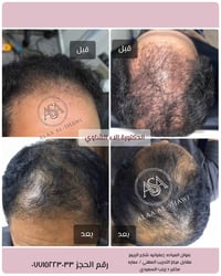 إنبات الشعر • جلسات إنبات الشعر • تكثيف الشعر • علاج تساقط الشعر • عيا...