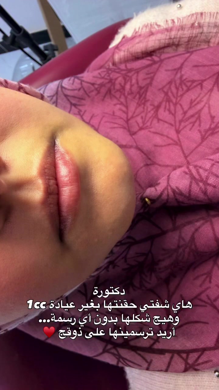 حقن فلر نوع سويسري
للحجز والاستفسار/***********0
الديوانية 📍#فلر_شفايف #فلر #تجميل #الديوانية #اكسبلور
