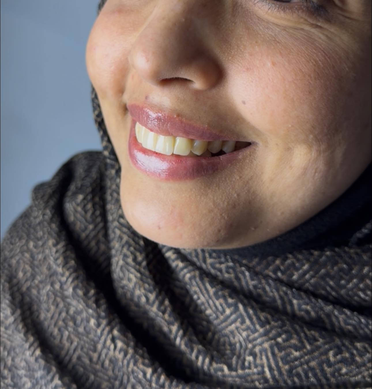 مو كل ابتسامة تنولد صح… بس الصح نعرف شلون نصلّحها 😌🦷

مراجعتنا جانت تعاني من تركيب أسنان سابق خطأ
❌ عدم تطابق
❌ صفر بالأسنان
❌ كسر وتشوه بالشكل
❌ ابتسامة مو مريحة لا نفسياً ولا شكلياً

📌 استلمنا الحالة من البداية
• شلّينا التركيب القديم بالكامل
• قيّمنا الحالة بدقة
• سوّينا تركيب جديد مدروس صحياً وجمالياً
• ركزنا على التناسق، الراحة، والابتسامة الطبيعية

✨ النتيجة؟
ابتسامة مرتّبة، ناعمة، وتفتح النفس
تركيب يليق بالوجه… مو مجرد أسنان!

💡 لأن الفرق مو بالتركيب
الفرق بالخبرة، التشخيص الصح، والشغل النظيف

📍 إذا عندك تجربة سابقة فاشلة
📍 إذا خايف/ة تعيدين الغلط
📍 إذا تريد ابتسامة ترجع ثقتك بنفسك

احنا هنا حتى نصلّح مو نجرّب ✔️

📞 للحجز والاستفسار:***********
📩 راسلينا خاص

#تصحيح_تركيب
#ابتسامة_تفرق
#طب_الأسنان
#حالات_قبل_وبعد
#ثقة
#SmileMakeover
#DentalCare
