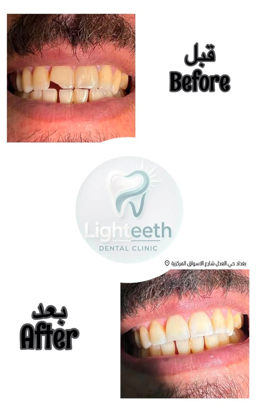 عيادةlighteeth
لدكتور
اسامة احمد الحسني
لزراعة وتقويم وتجميل الاسنان توجد خدمة طوارئ الاسنان
وتتواجد طبيبة 
تجميل أخصائية
فلروبوتوكس ونضارة للوجهه
أوقات الدوام
من الساعة ال ١٠ صباحاٍ حتى الساعة ال ١٠ مساءا
موقع العيادة:
حي العدل
-شارع الأسواق المركزية -
مجاور حاجة الف
لحجز واتساب او التواصل عبر الخاص.
***********
