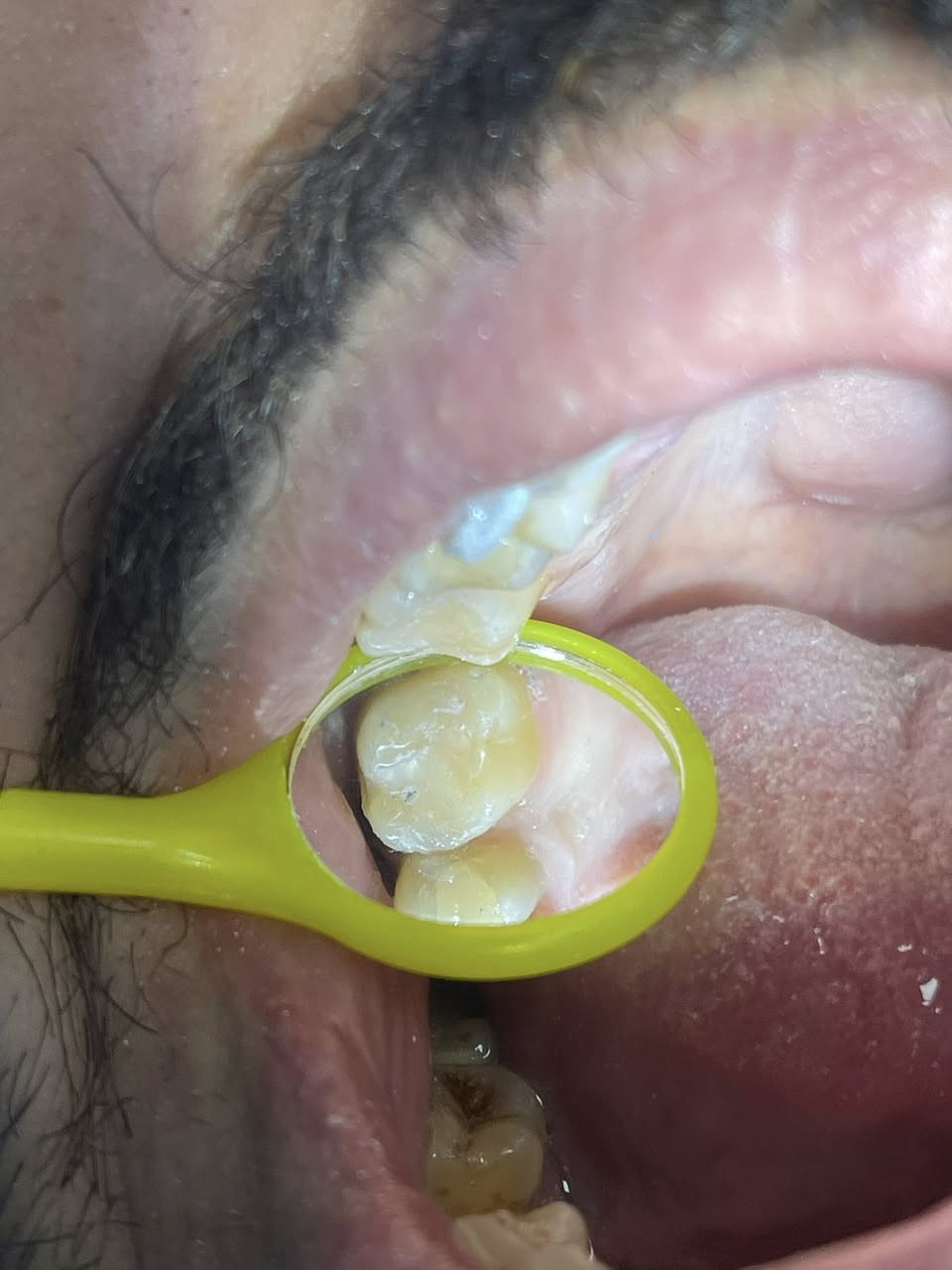 السلام عليكم 
اي شخص محتاج علاج لاسنانه خلي يتواصل وياي 
حشوات ضوئية وتجميلية  
تنظيف وتبيض الاسنان 
قلع الاسنان والجذور التالفه 
تركيب وتعويض الاسنان المفقوده 
***********
علماً ان العلاج مجاني لفتره محدوده
