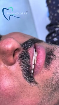 ابتسامة زركون • شفايفة عالية • بسماية