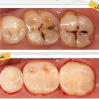 المدينة القديمة • حشوات ضوئية • علاج تسوس