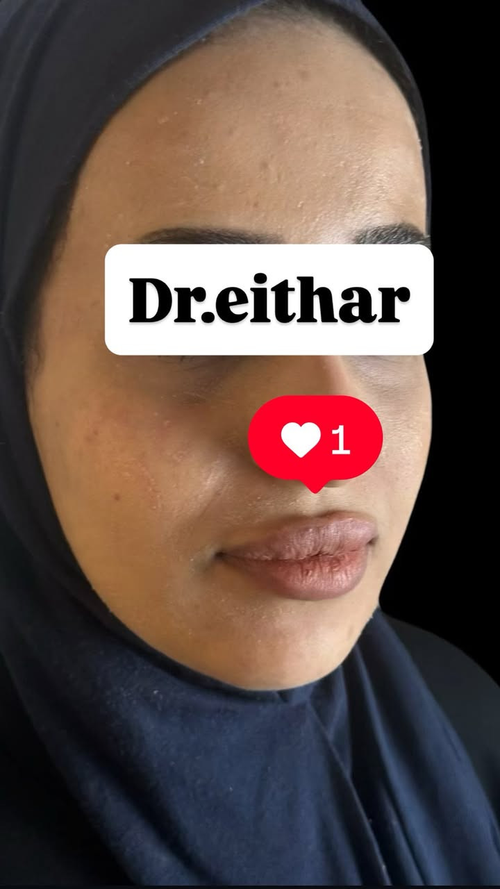 استداره وجه كامله بطريقة الشد (لفتنك وجنات واصداغ  وتدوير الفك والذقن  ونظاره  )وتعديل ع حقن سابق للشفه بدون تذويب

لاحضو شون الوجه  قبل الحقن ضعيف ونازل والذقن مابي تحديد وخسفات بالاصداغ  والشفه بس امتلاء ومابيهه رسمه قبل التعديل 
وبعد الحقن انرفع وانسحب واتحدد بطريقه بينت الوجه انعم وانثوي 👌

عروض العيد نزلتهه الكم بالستوري بالهايلايت مستمره لحد العيد  🔥

د.ايثار سامي عبد الامير
الكوت_واسط _الهوره_مجمع القبطان

الحجز***********
