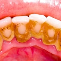 تنظيف اسنان مجاني • عيادات جامعة المنارة