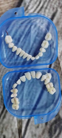 أسنان تعويضية • أسنان صناعية • طقم أسنان