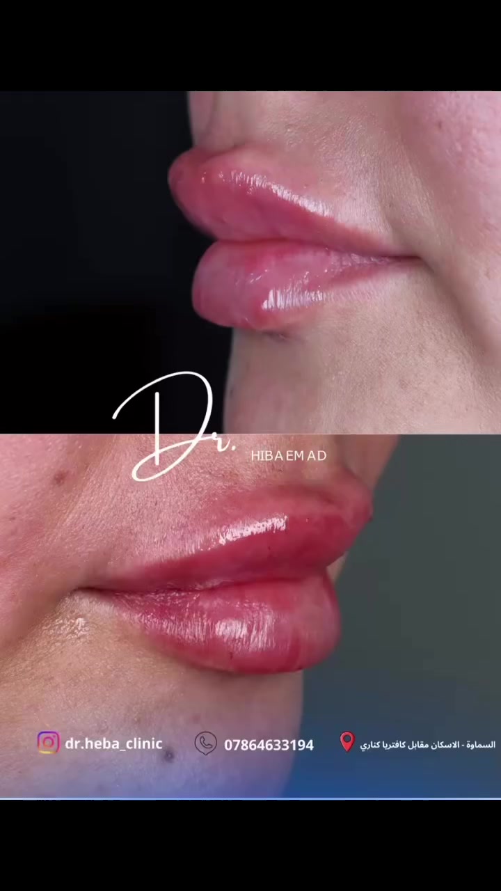 تغيير بسيط.. فرق كبير! ✨
حقن 1 سيسي من الفيلر كان كفيل بإخفاء الخطوط التعبيرية المزعجة، ومنح الشفاه مظهر حيوي وناعم بعيداً عن المبالغة.
الجمال دائماً يكمن في التفاصيل البسيطة. 💄
▫️ بإشراف: الدكتورة هبة عماد
(تجميل الأسنان والبشرة)
للحجز والاستفسار
📞 ***********
📍 السماوة - الاسكان - مقابل كافتريا كناري
 #
