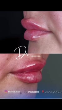 فيلر ١سيسي • د. هبة عماد • السماوة الاسكان