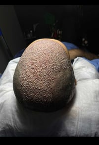 الناصرية • زراعة شعر • معاينة مجانية
